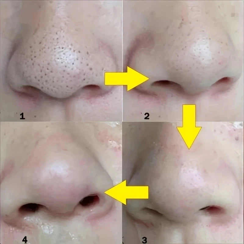 SkinPurify Nose Strips – Black Dot Remover Deep Cleansing & Pore Care