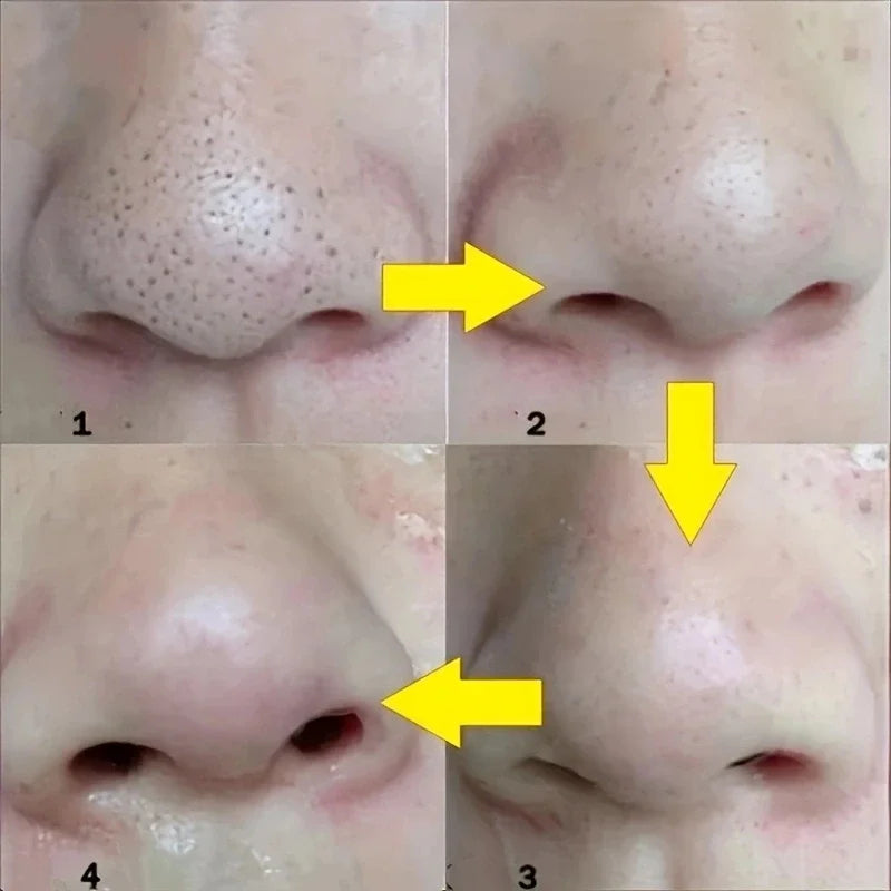 SkinPurify Nose Strips – Black Dot Remover Deep Cleansing & Pore Care