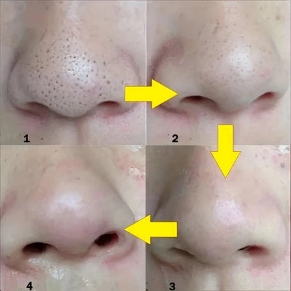 SkinPurify Nose Strips – Black Dot Remover Deep Cleansing & Pore Care